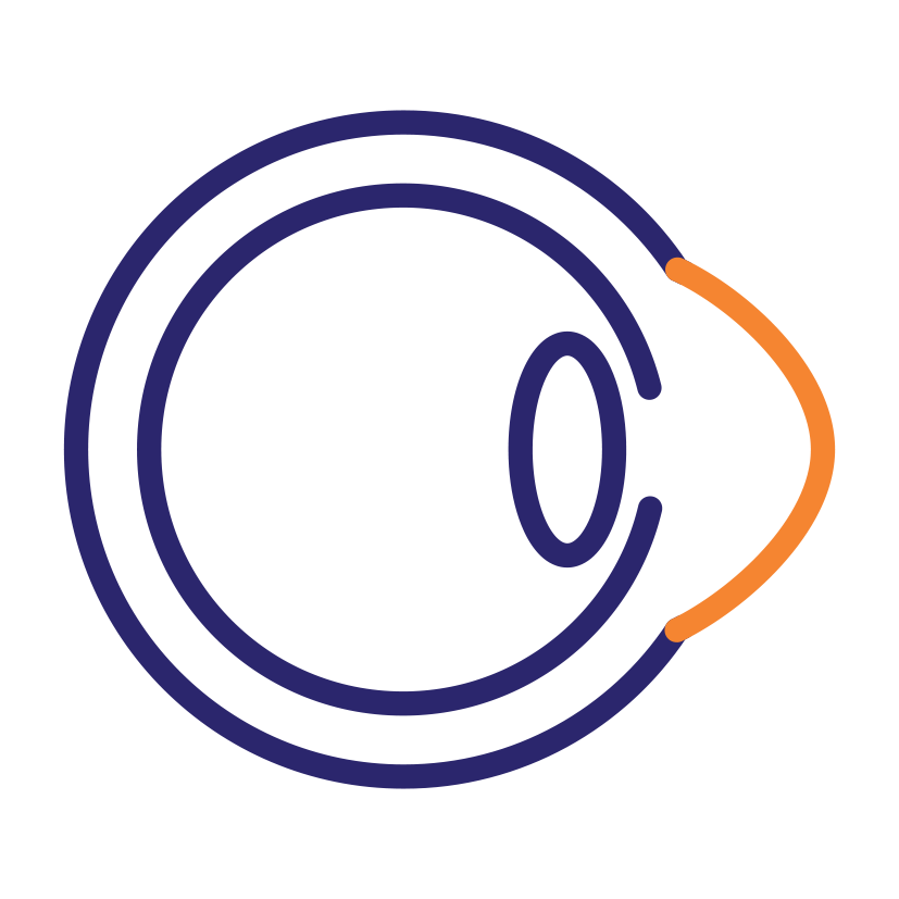Keratoconus