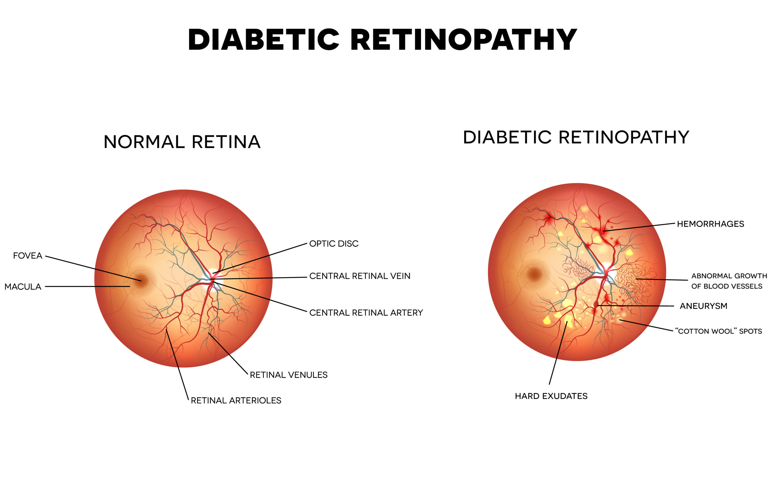 Diabetic Retinopathy Symptoms Causes Treatment Lions Eye Institute