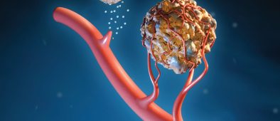 A new vision for earlier cancer detection