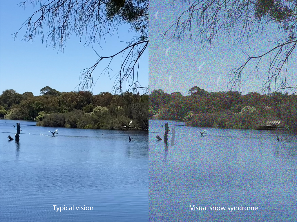 An illustration of how people with visual snow syndrome experience vision. Typical vision is depicted on the left, while the right illustrates some of the key visual symptoms of visual snow syndrome.